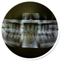 Oral examination/X-ray examination/periodontal disease check