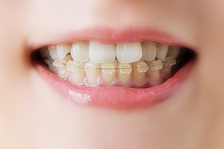 Minimal tooth movement